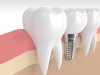 Sparkle with Every Smile Using Dental Implants in Dubai