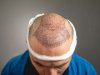 Who is the ideal candidate for a hair transplant?