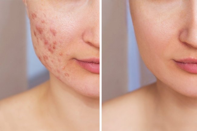 Clear Skin Journey: A Natural Approach to Managing Acne