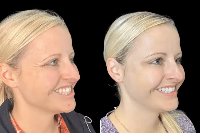 Natural-Looking Botox Results: Tips from the Best Doctors in dubai