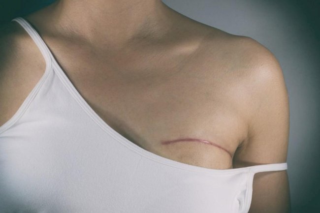 The Importance of Choosing the Right Breast Cancer Reconstruction Specialist