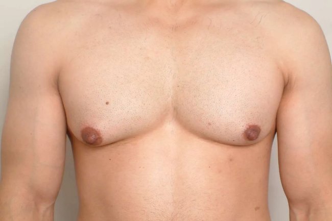 Does Weight Loss Eliminate Gynecomastia Completely?