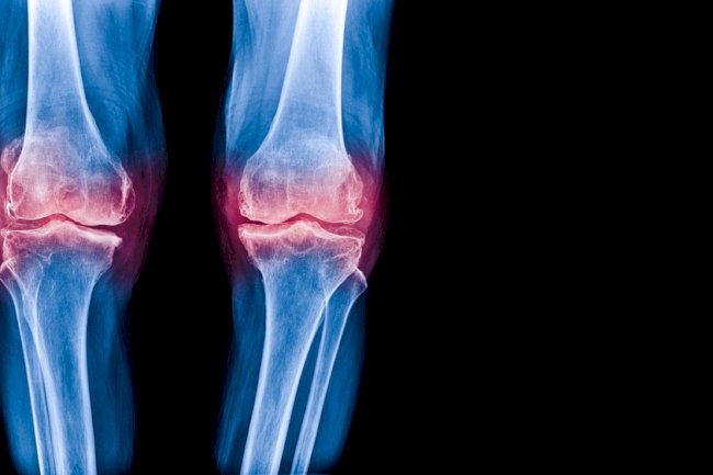 Is Sclerosis the Same as Osteoarthritis? Here’s What You Need to Know 