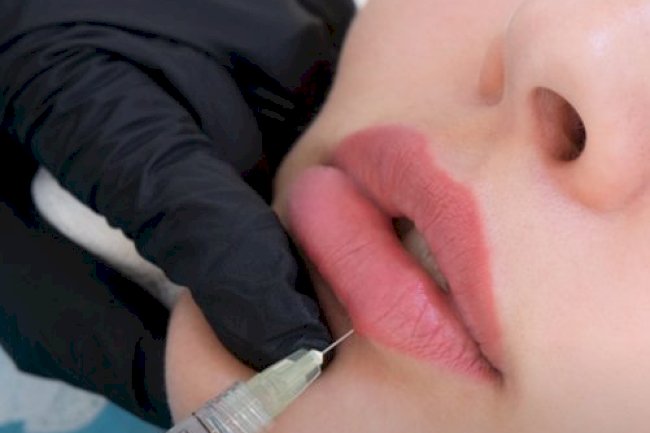 How Many Syringes Are Needed for Russian Lip Look?