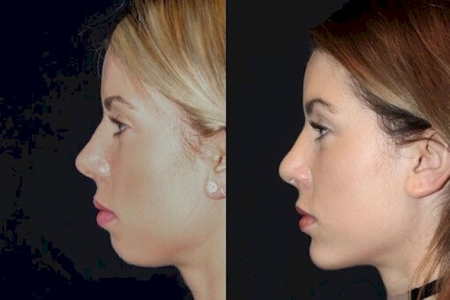 Best Plastic Surgeon in dubai for Chin Fillers: Affordable and Effective