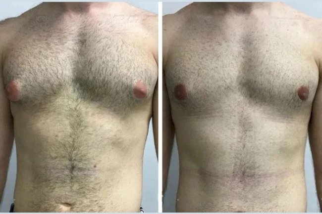 Before and After Gynecomastia: Real Results from the Best Doctors in Dubai