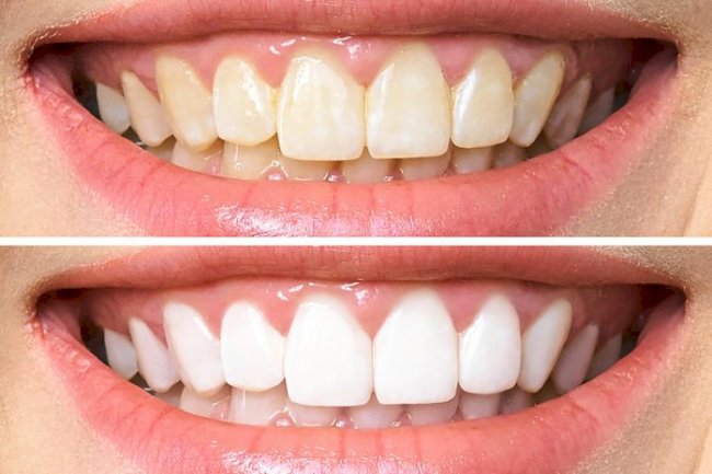 Teeth Whitening Cost or At-Home Kits: Which Lasts Longer?