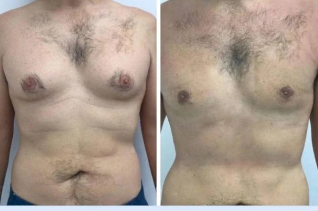 How the Best Gynecomastia Surgeons in Dubai Minimize Scarring