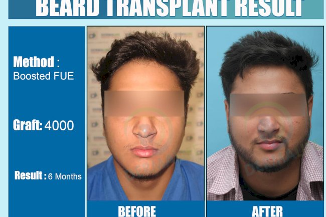Understanding the Need for Beard Hair Transplant