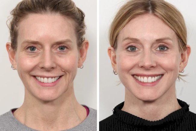 Advanced Thread Lift Techniques at the Best Aesthetic Clinic in Dubai