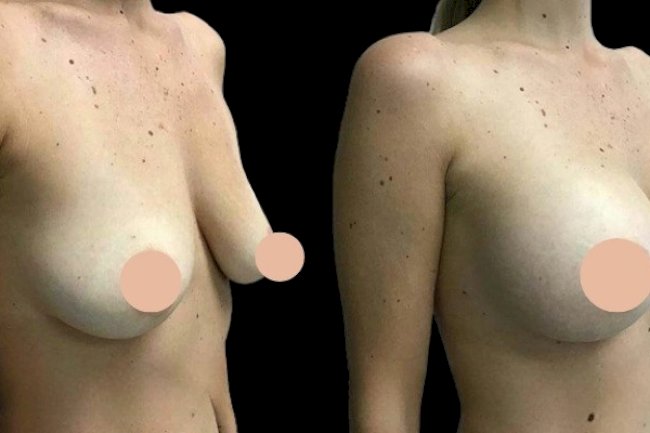 Best Doctors in Dubai Share What to Expect During Breast Augmentation Recovery