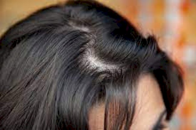Hair Loss Treatment or Hair Transplant: Which Should You Choose?