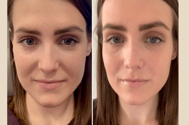 Best Plastic Surgeon in dubai for PRP Treatment for Men and Women