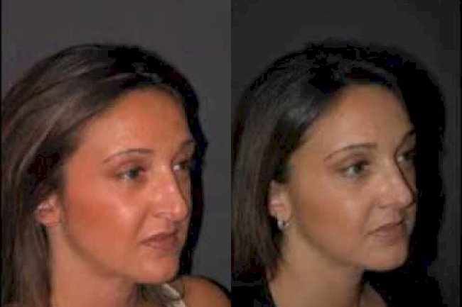 Revision Rhinoplasty in Riyadh: How to Fix a Previous Surgery
