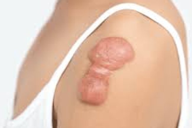 Non-Invasive Solutions for Keloid Scars