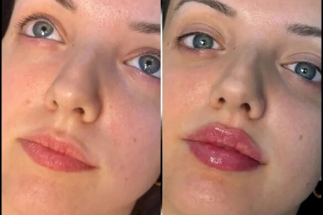 Achieve Youthful Skin with the Best Plastic Surgeons in Dubai for Fillers
