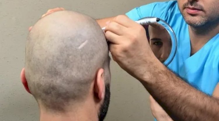 Hair Transplant in Dubai – Restore Hair. Reclaim Confidence.