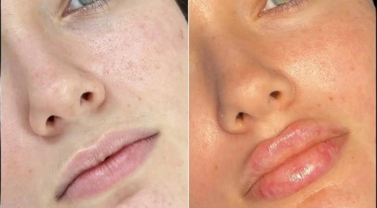 Sculpt Your Face with Fillers Treatment in Dubai