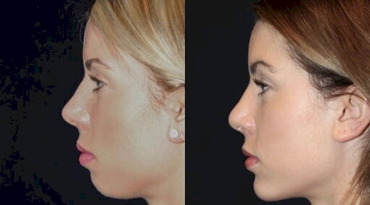 How Chin Fillers Treatment in Dubai Can Boost Your Confidence