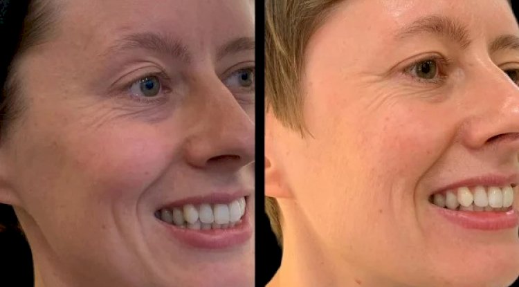 The Best Doctors in Dubai for Profhilo Understanding the Procedure and Its Benefits