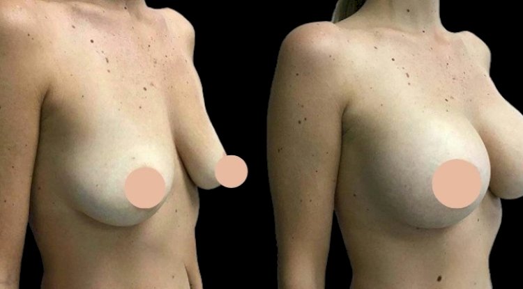 Why Safety Comes First with the Best Doctors in Dubai for Breast Augmentation Surgery