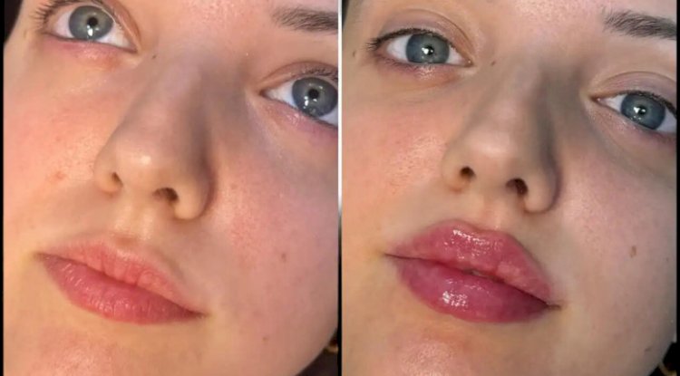 Fillers Treatments in Dubai: Ideal Treatments for Every Age