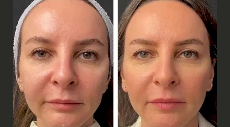 How the Best Aesthetic Clinics in Dubai Customize Mesotherapy for Every Skin Type