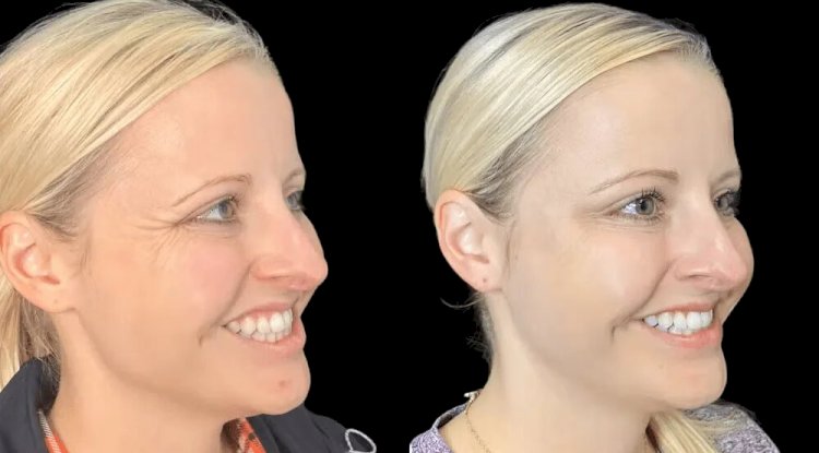 Why the Best Aesthetic Clinics in dubai Are Leading the Botox Industry