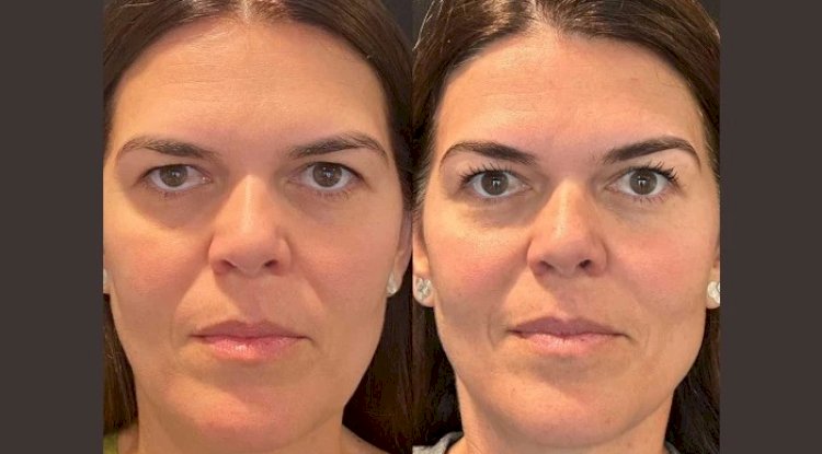 Recovery Tips After a Thread Lift from the Best Plastic Surgeon in Dubai
