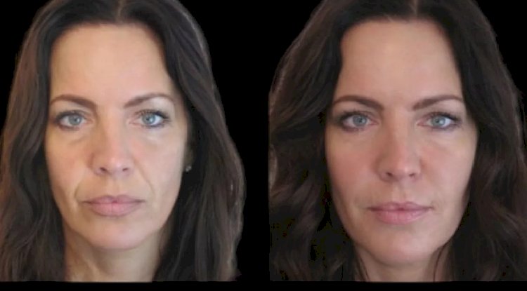 Achieve a Sculpted Jawline with the Best Plastic Surgeon in Dubai for Jawline Fillers