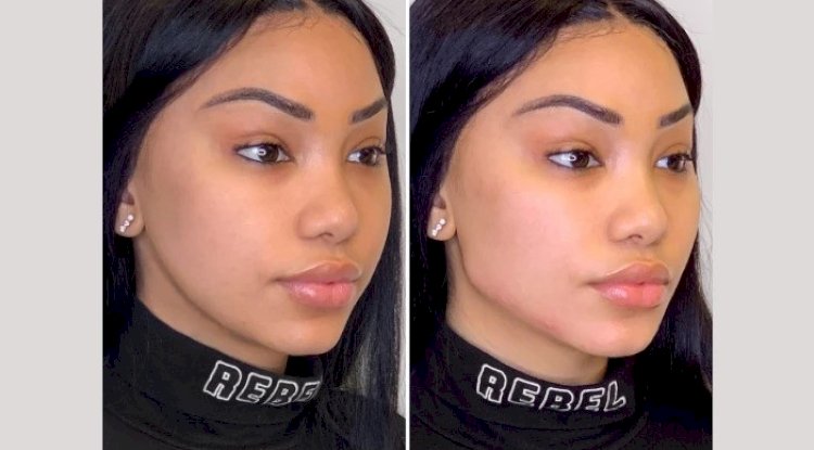 Comparing Facelift vs. Thread Lift Treatment in Dubai
