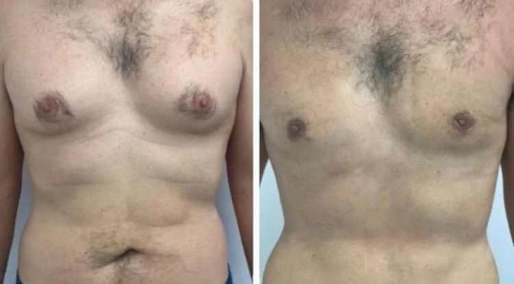 Gynecomastia Surgery In Dubai: Stunning Before and After Transformations