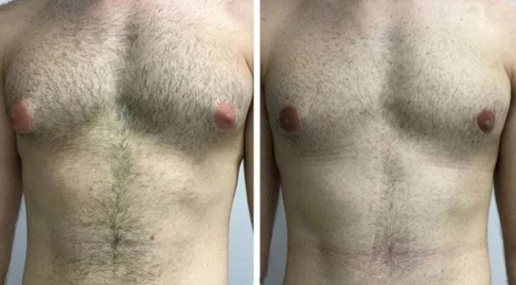 Treating Gynecomastia in Dubai with Hormone Therapy