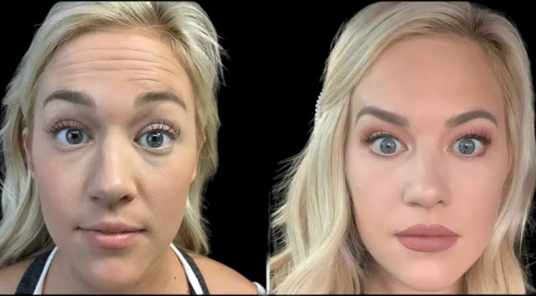 Combining Laser Treatments with Botox in Dubai: What You Need to Know