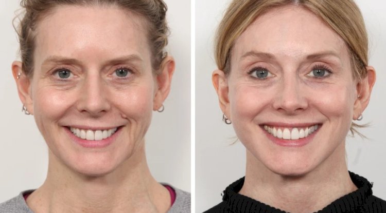 Best Plastic Surgeon in Dubai Shares Signs You’re Ready for a Thread Lift