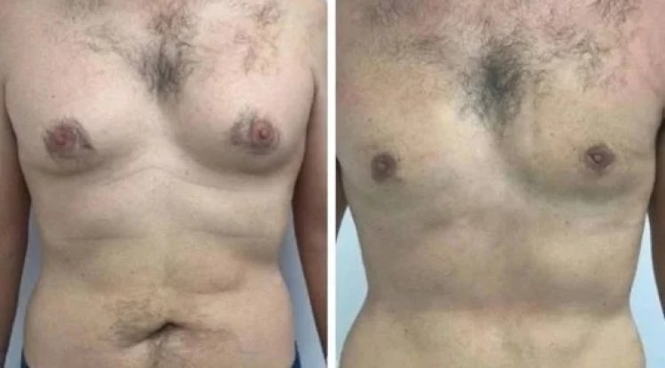 Gynecomastia Surgery in dubai for Health and Aesthetic Goals