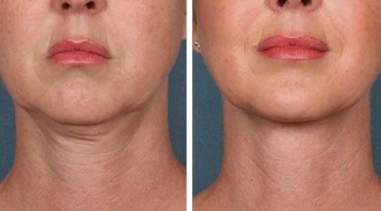 Best Doctors in Dubai for Affordable PRP Treatment