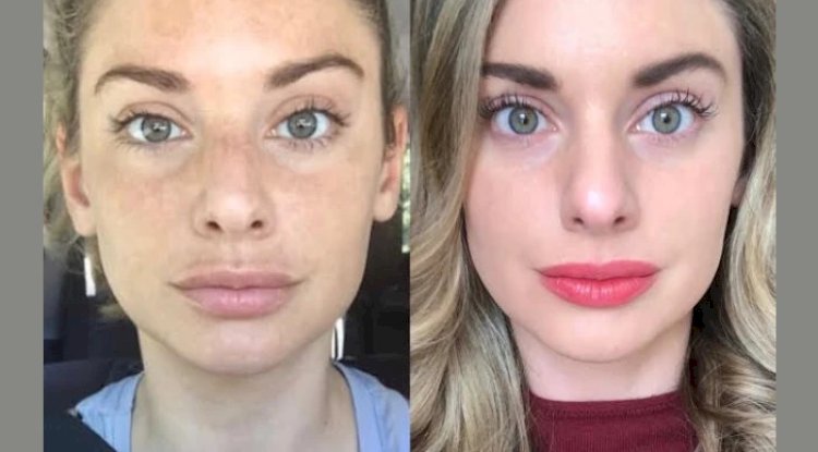 Non-Surgical Skin Lifting by the Best Plastic Surgeons in Dubai for Radiofrequency (RF) Microneedling