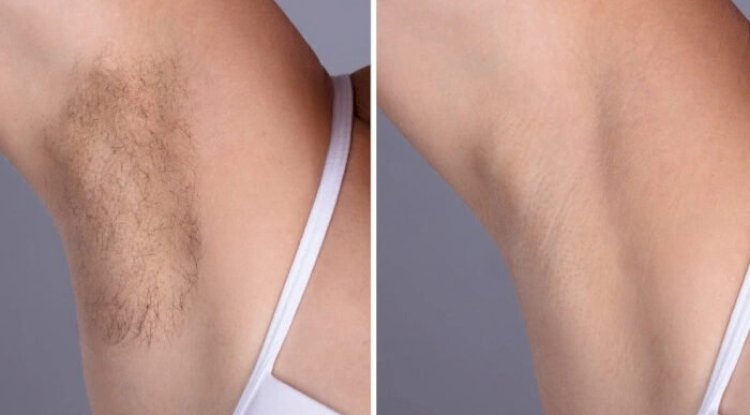Best Aesthetic Clinic in dubai: Electrolysis Laser Hair Removal Aftercare