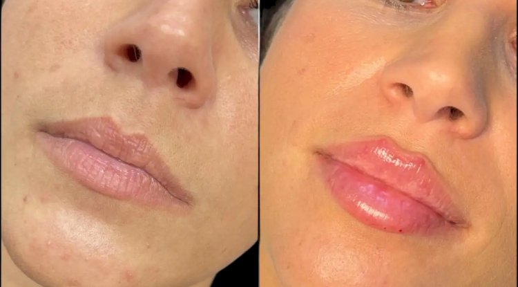 Dermal Fillers in Dubai for a Fresh and Radiant Look