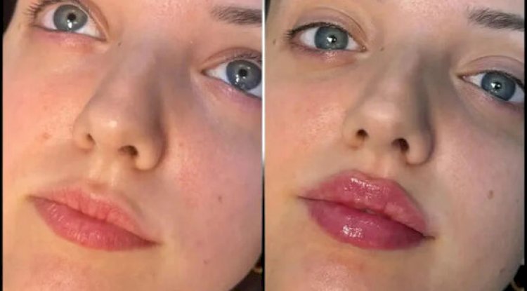 Best Plastic Surgeons in Dubai for Fillers and Refined Contours