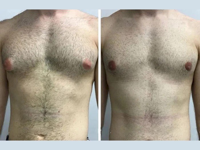 Latest Technology Used in Gynecomastia Surgery in Dubai