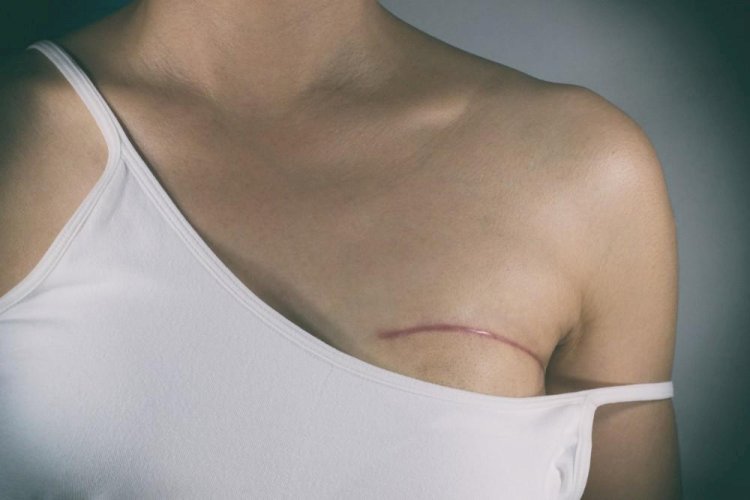 The Importance of Choosing the Right Breast Cancer Reconstruction Specialist