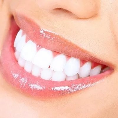 How Teeth Whitening Cost Matches Expectations