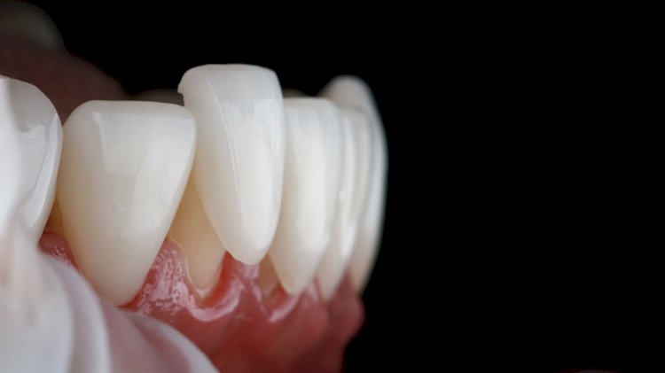 The Role of Dental Veneers in Cosmetic Dentistry: Trends and Innovations