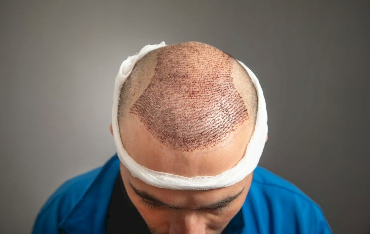 Who is the ideal candidate for a hair transplant?