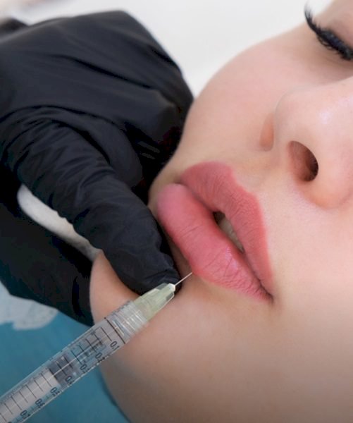 How Many Syringes Are Needed for Russian Lip Look?