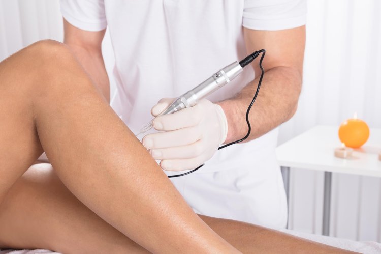 How MCA Microneedling Targets Stretch Marks for Visible Skin Renewal