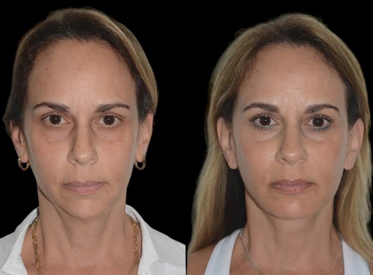 Best Aesthetic Clinics in Dubai for Chin Fillers: Enhance Your Facial Contours