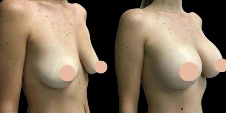 Natural-Looking Breast Enhancements by the Best Breast Augmentation Surgeons in Dubai